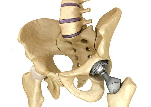 Internal opthetics of the hip joint