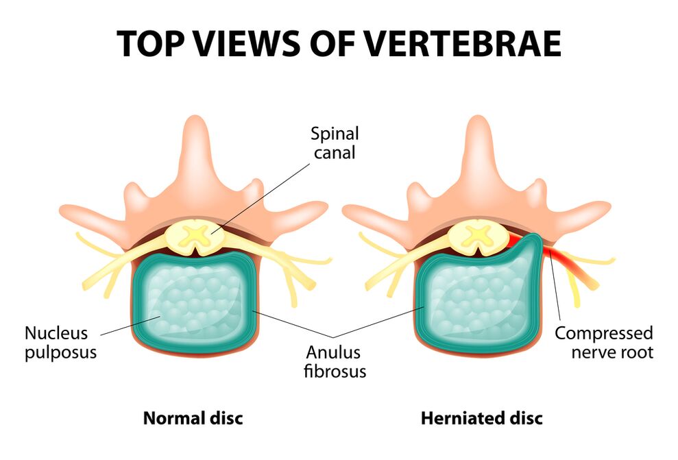 Healthy discs and hernia