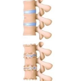 Causes of osteochondrosis