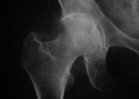 X-ray of hip joint with arthrosis