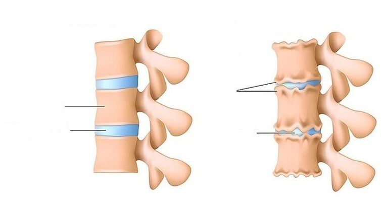 Healthy Spine and Spine Affected by Osteochondrosis