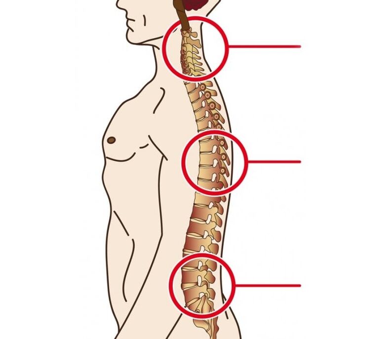 Location of cervical, thoracic and lumbar osteochondrosis
