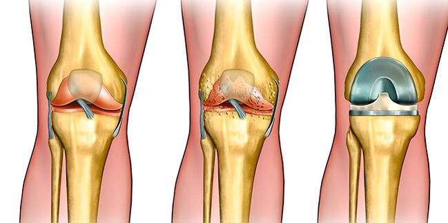 In the third stage of arthrosis, knee replacement surgery is required