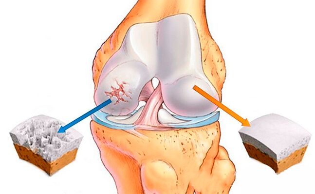 Normal knee (right) and affected knee (left)