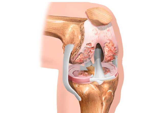 knee arthritis