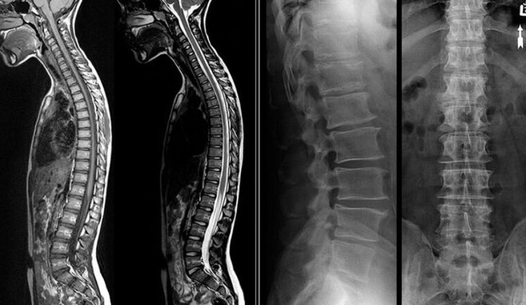 X-ray and MRI pictures of osteochondrosis