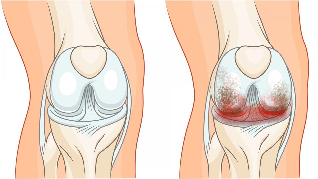 Healthy joints and arthropathy of the knee