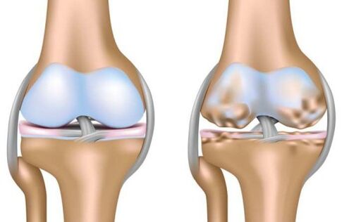 Healthy joints and knee joint destruction in arthropathy