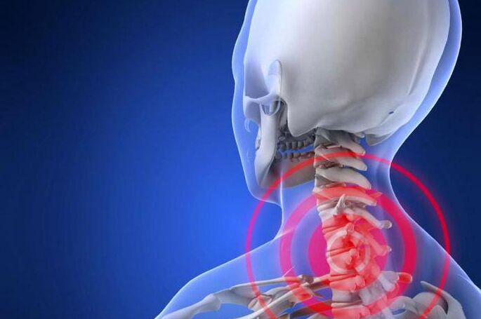 Severe neck pain - early symptoms of cervical osteochondrosis