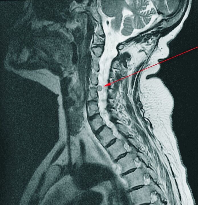 Cervical hernia on MRI