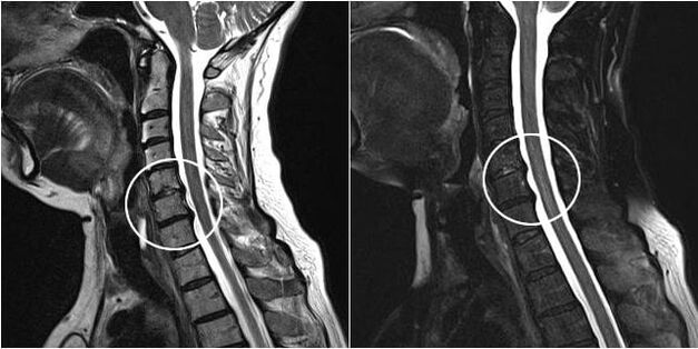 Cervical spine MRI and signs of osteochondrosis