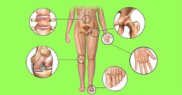 Joints Affected by Arthritis and Arthropathy