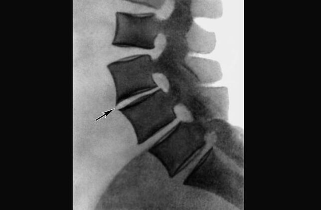 Manifestations of thoracic vertebral osteochondrosis on X-ray films