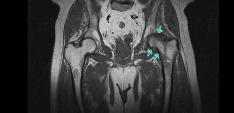 Degenerative dystrophic changes of the hip joint on MRI