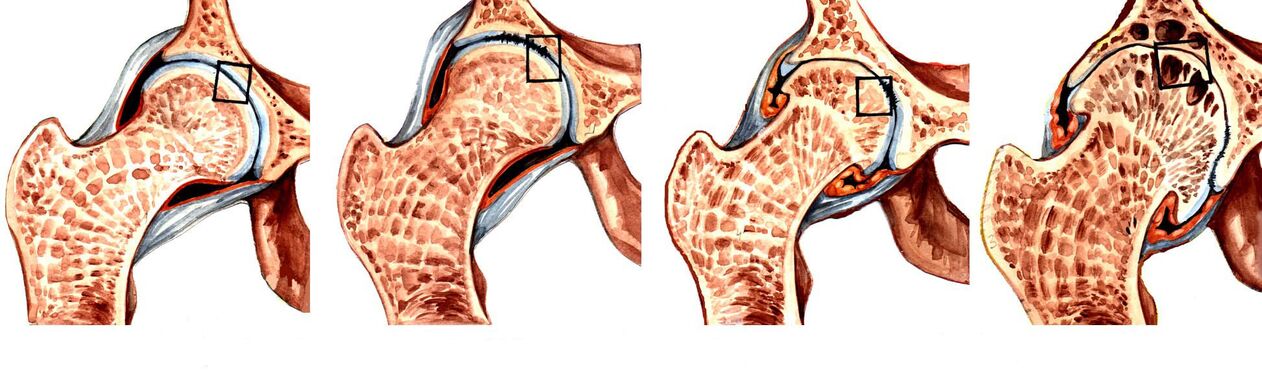 Degree of deformity of the hip