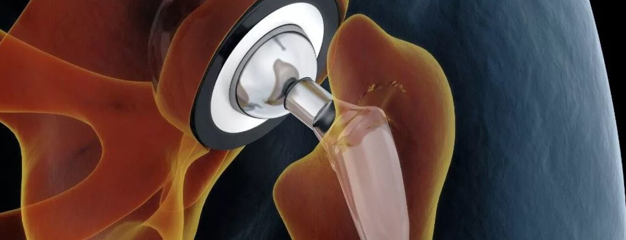 End-stage hip disease hip endoprosthesis