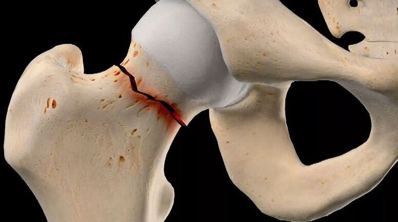 Femoral neck fractures are one of the causes of secondary hip arthropathy. 