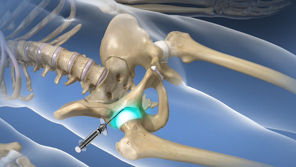 Intra-articular block to relieve acute pain of hip arthropathy