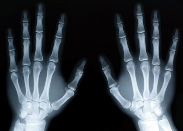 Gout causes gouty arthritis, which can be diagnosed with X-rays